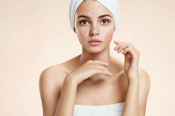 Acne Treatment Options at Beam & Bare