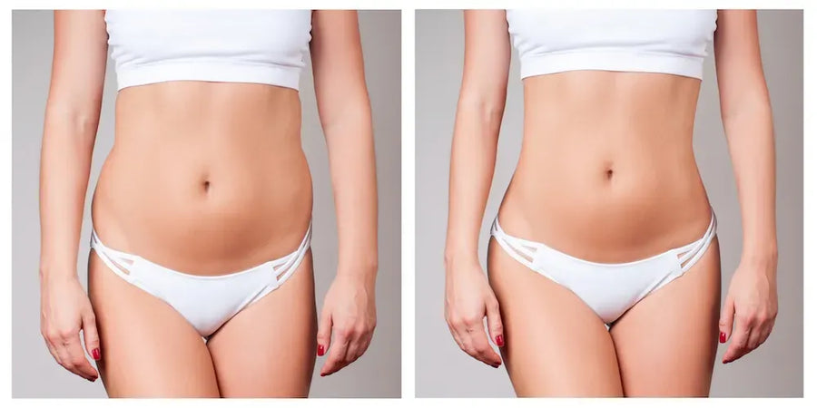 truSculpt treatments