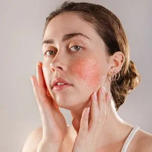 Rosacea