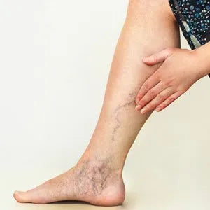 How Laser Vein Therapy Works