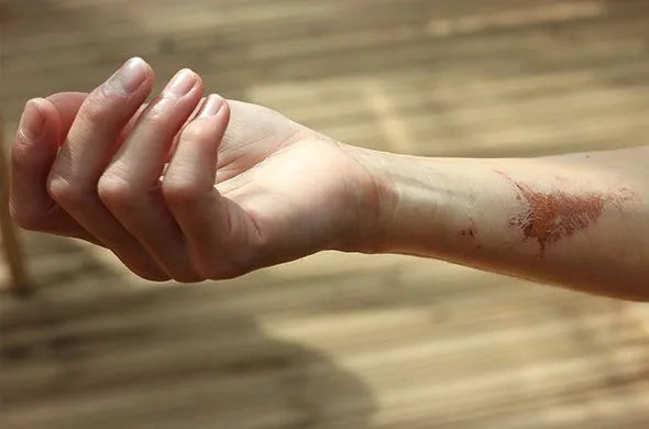 Scars