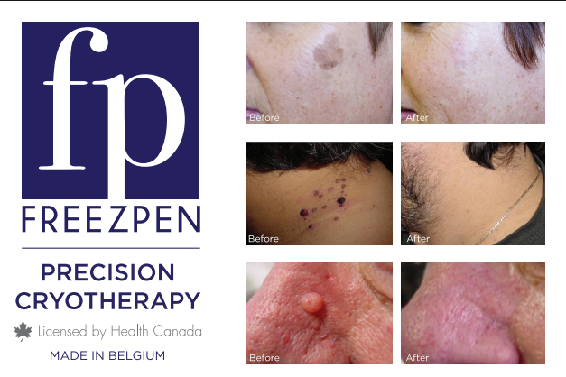 What Is FreezPen Cryotherapy?